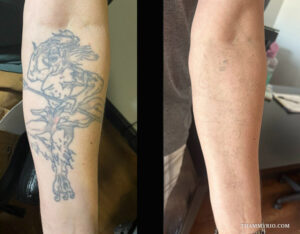 Before and after laser tattoo removal for military on inner forearm showing a full mythological creature being removed.