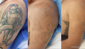 Progress of tattoo removal for military service on upper arm showing ink fading.