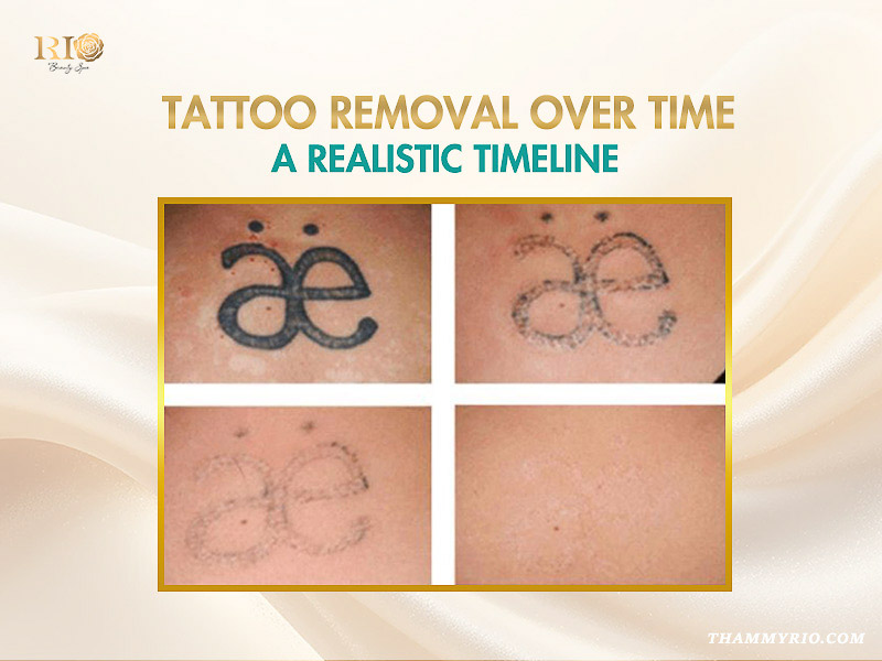 Tattoo removal over time process showing a black ink symbol fading completely across four stages.