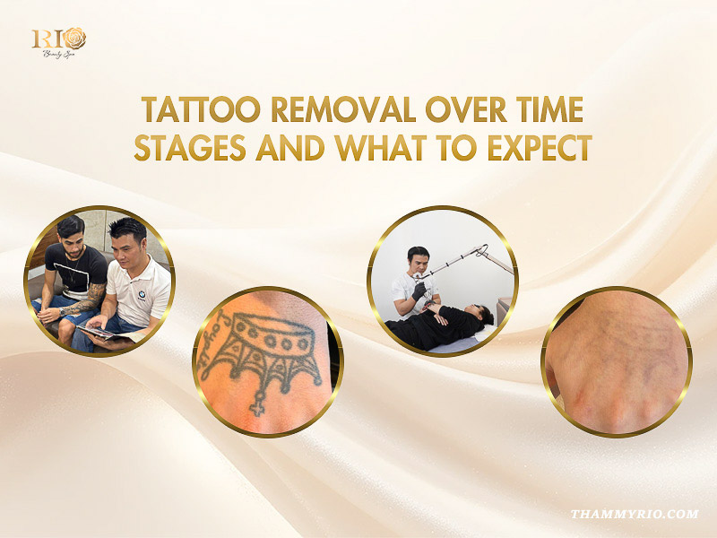 Tattoo removal over time stages including consultation, laser treatment on a crown tattoo, and the final faded result.