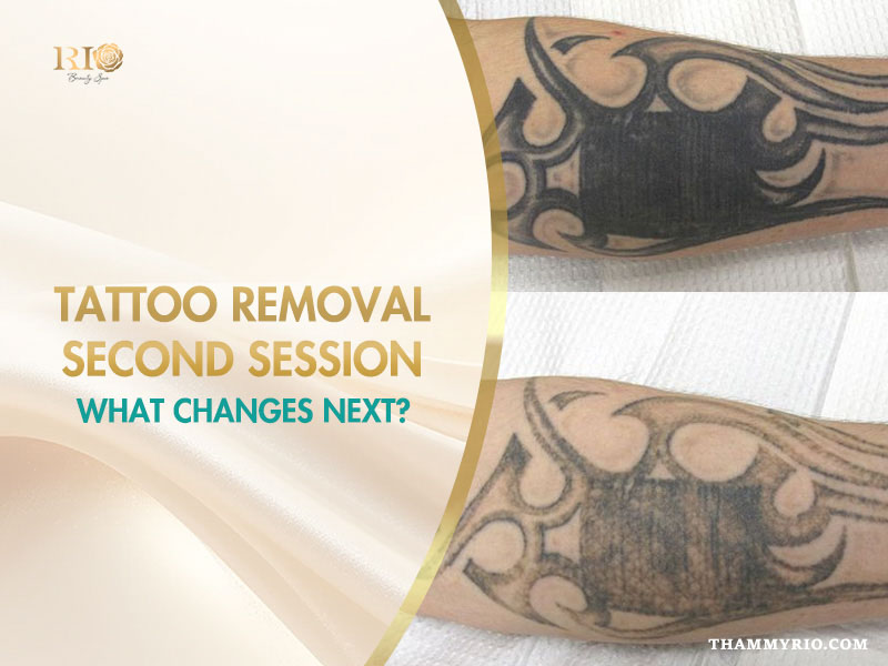 Tribal arm tattoo fading progress after tattoo removal second session at Rio Beauty Spa.