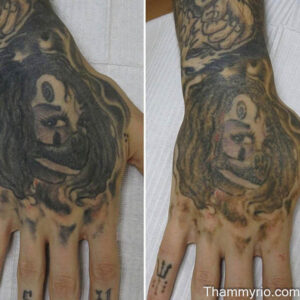 Hand portrait tattoo fading progress after tattoo removal second session results.