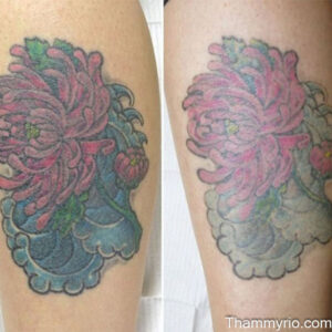 Color tattoo fading progress on a flower design after tattoo removal second session.