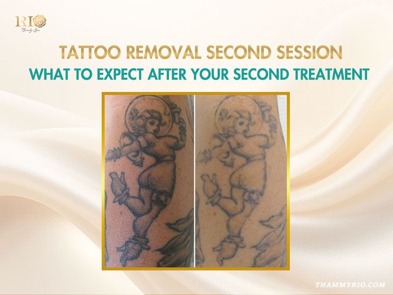 Comparison of a cartoon character tattoo fading after tattoo removal second session at Rio Beauty Spa.