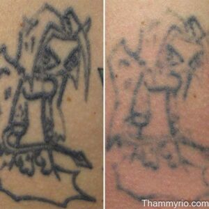 Fine line cartoon tattoo fading progress after tattoo removal second session results.