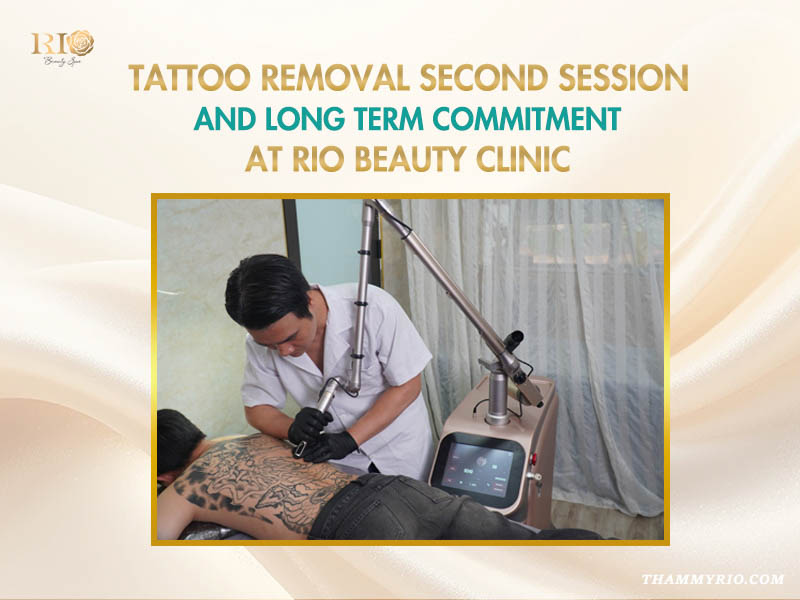 Professional tattoo removal second session using advanced laser technology at Rio Beauty Clinic.