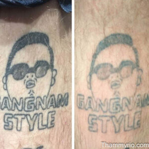 Tattoo removal second session: what changes next? - Thẩm Mỹ Rio Beauty Clinic