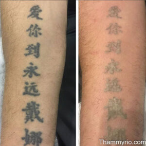 Tattoo removal second session: what changes next? 1 - Thẩm Mỹ Rio Beauty Clinic