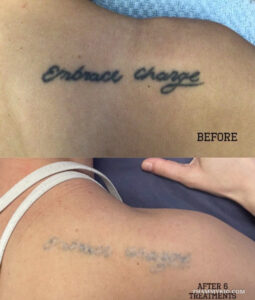 Tattoo removal success before and after 6 laser treatments for a black ink text tattoo on the shoulder.