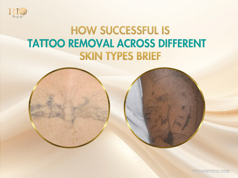 Tattoo removal success across different skin types showing laser progress on light and dark skin tones.