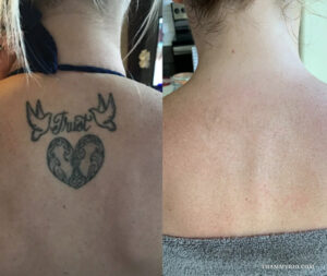 Tattoo removal success showing total clearance of a back tattoo featuring birds, a heart, and the word trust.