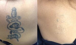 Tattoo removal success before and after laser treatment for a snake wrapped around a dagger tattoo on the skin.