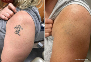 Tattoo removal success before and after laser treatment for a black kanji character tattoo on the upper arm.