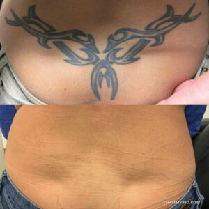 Tattoo removal success before and after showing complete elimination of a large tribal tattoo on the lower back.