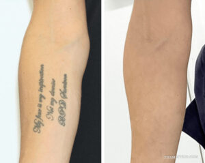 Tattoo removal success before and after on forearm showing complete removal of script text 'My fear is my inspiration Not my demise BPD Survivor'.