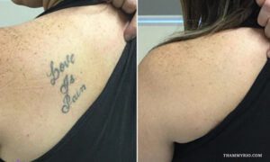 Tattoo removal success before and after on a freckled shoulder showing complete removal of 'Love is pain' text.