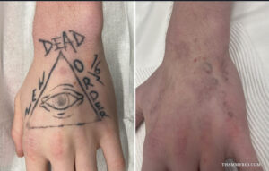 Tattoo removal success before and after showing significant fading of a hand tattoo with an eye in a triangle and text.