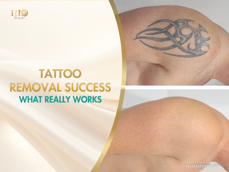 Before and after collage showing total clearing of a black tribal tattoo, titled 'Tattoo removal success'.