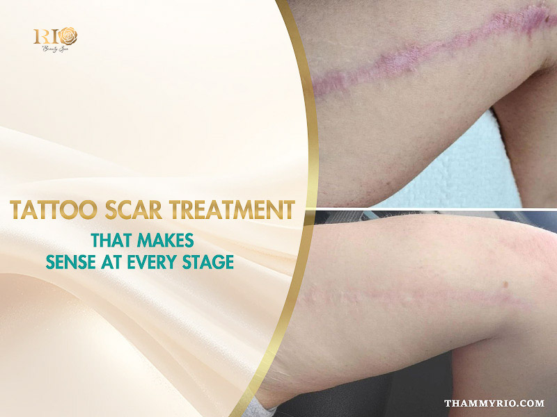 Before and after comparison of a raised pink tattoo scar treatment on a leg, demonstrating a significant reduction in scar texture and discoloration.