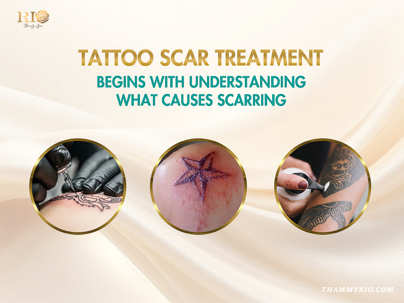 Three circular icons showing the process of getting inked, an infected star tattoo, and aftercare lotion application to explain tattoo scar treatment causes.