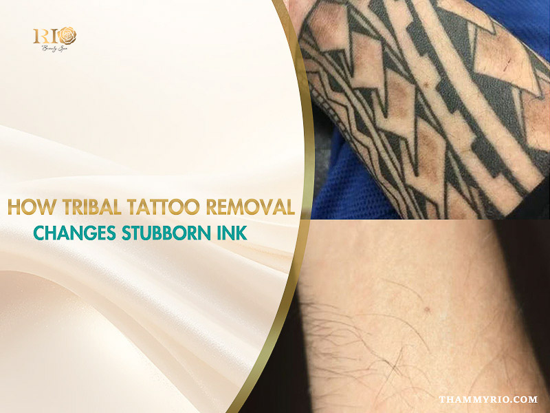 Before and after results of tribal tattoo removal on an arm at Rio Beauty Spa.