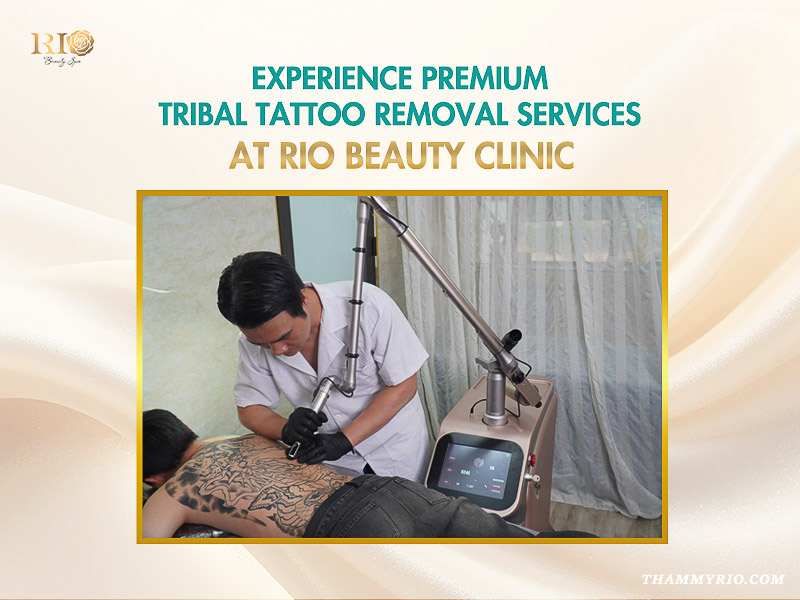 A specialist performing premium tribal tattoo removal on a client's back at Rio Beauty Clinic.