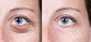 Under eye laser treatment before and after comparison showing reduction in dark circles and fine lines.
