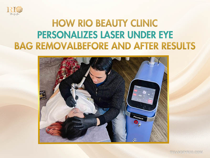 Professional under eye laser treatment before and after process conducted by an expert at Rio Beauty Clinic.
