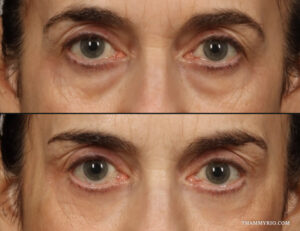 Under eye laser treatment before and after showing significant reduction in eye bags and sagging skin.
