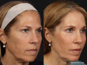 Before and after photos of a woman who received under eye laser treatment to reduce wrinkles and dark circles.