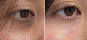 Real case of under eye laser treatment before and after, showing drastic reduction in dark pigmentation and wrinkles.