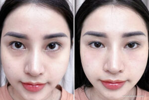 Authentic case of under eye laser treatment before and after, showing severe dark circle reduction and skin brightening.