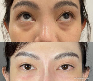 Real results of under eye laser treatment before and after for heavy eye bags and dark circles.