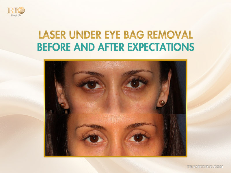Realistic case of under eye laser treatment before and after for severe eye bags and dark circles.