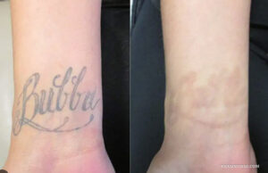 A comparison showing wrist tattoo removal before and after results on a forearm.