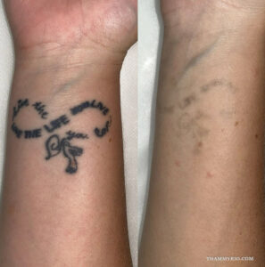 Wrist tattoo removal before and after comparison of an infinity quote tattoo.