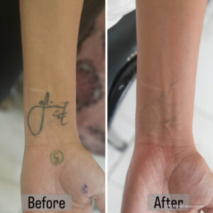 Wrist tattoo removal before and after results of a cursive Bubba name tattoo.