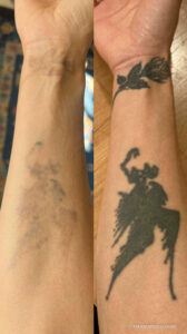 Wrist tattoo removal before and after showing fading of a rose and silhouette tattoo on the forearm.