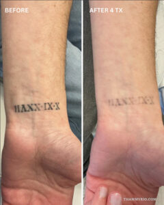 Wrist tattoo removal before and after results showing a Roman numeral tattoo fading after 4 sessions.