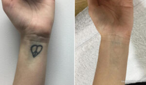 Wrist tattoo removal before and after results of a heart peace symbol tattoo.