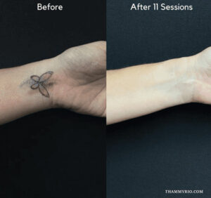 Wrist tattoo removal before and after showing a small animal face outline fading.