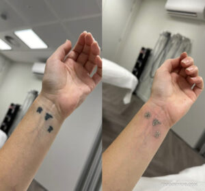 Wrist tattoo removal before and after showing laser frosting on three small wrist tattoos.