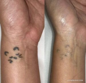 Wrist tattoo removal before and after comparison featuring fading of a small animal face design on a forearm.