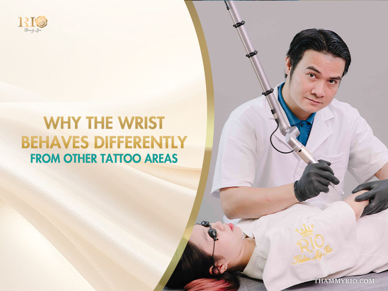 Professional laser wrist tattoo removal procedure being performed at Rio Beauty Spa.