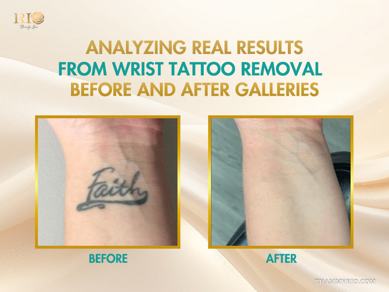Real comparison analyzing results from wrist tattoo removal before and after galleries.
