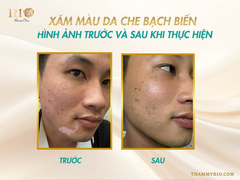 Xăm che phủ bạch biến chuyên nghiệp tại Rio Beauty Clinic, khôi phục tông màu da tự nhiên một cách hoàn hảo.