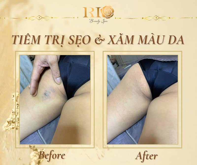 Kỹ thuật xăm màu da che sẹo vùng kín an toàn, thẩm mỹ và riêng tư tại Rio Beauty Clinic.