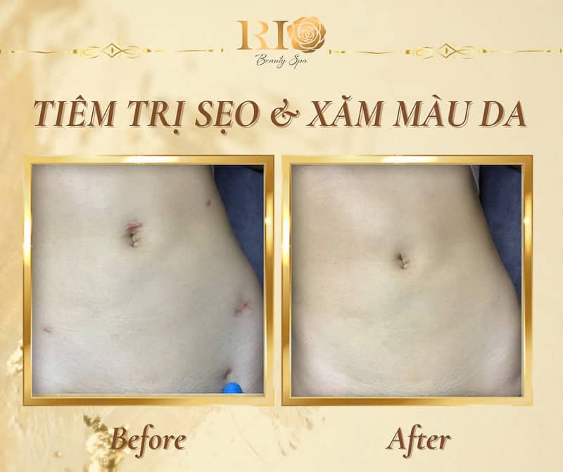 Kỹ thuật xăm màu da che sẹo mổ nội soi bụng chuyên nghiệp tại Rio Beauty Clinic.