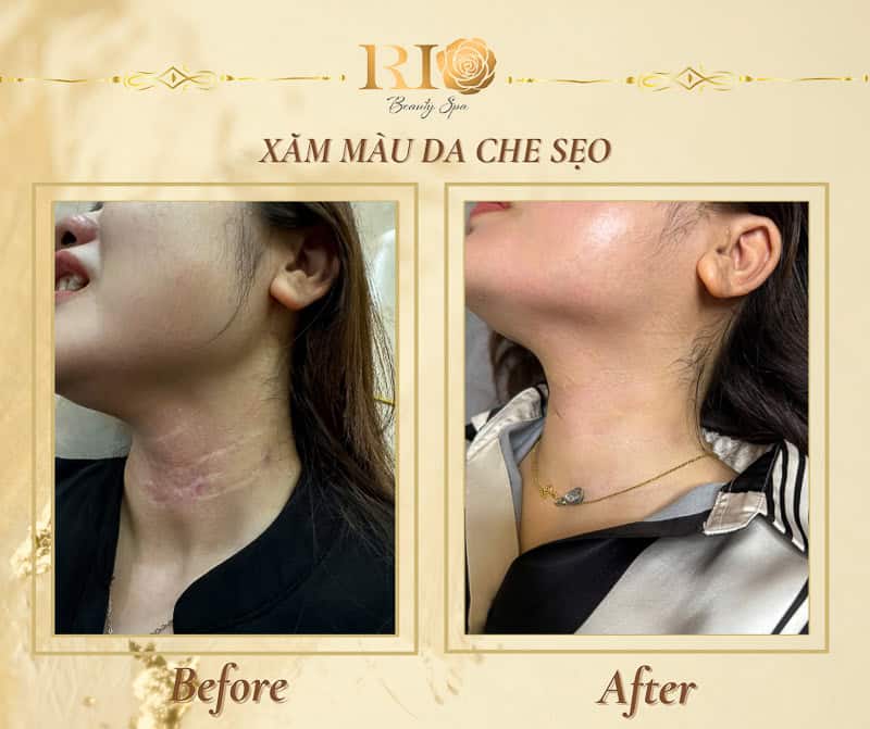 Tại sao xăm màu da che sẹo là giải pháp che vết sẹo nhanh chóng và hiệu quả nhất hiện nay?