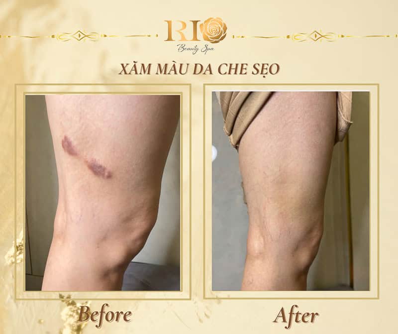Giải pháp xăm màu da che sẹo ở đùi giúp chị em tự tin diện váy ngắn tại Rio Beauty Clinic.